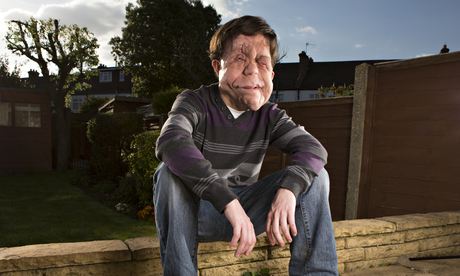 Photo of a man with neurofibromatosis.