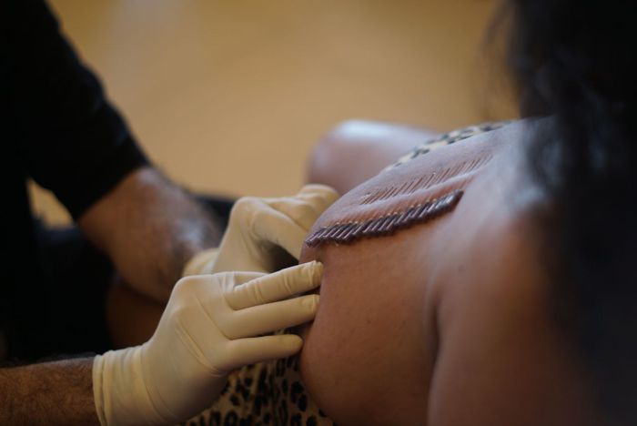 A photo of a row of needles pierced through the back of a participant during a needle workshop.